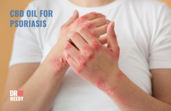 CBD Oil for Psoriasis