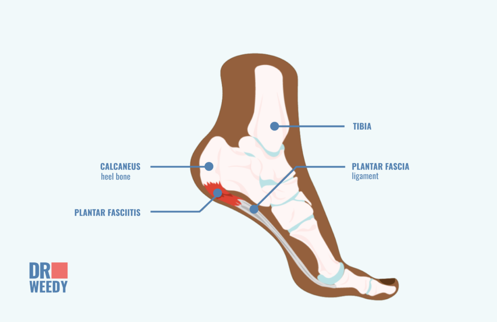 What is Plantar Fasciitis?