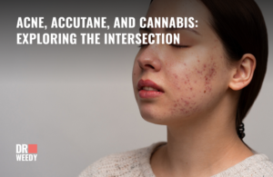 Acne, Accutane, and Cannabis: Exploring the Intersection