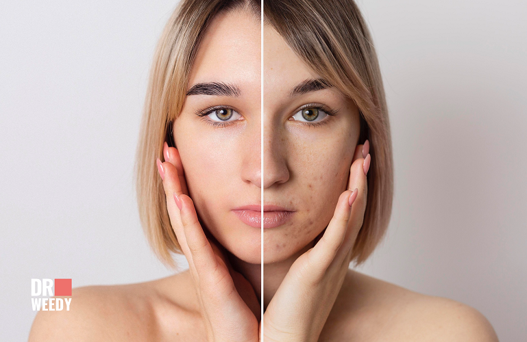 The Power of Accutane: A Last-Resort Acne Treatment 
